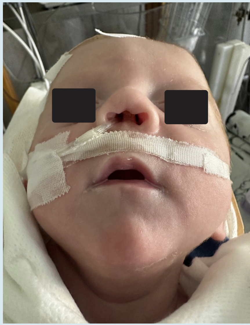 La presencia de lesiones por presión asociadas a dispositivos médicos pueden causas daño permanente así como desfiguraciones a estructuras faciales delicadas, en particular, al cartílago hialino con consecuencias a largo plazo así como consecuencias psicológicas.